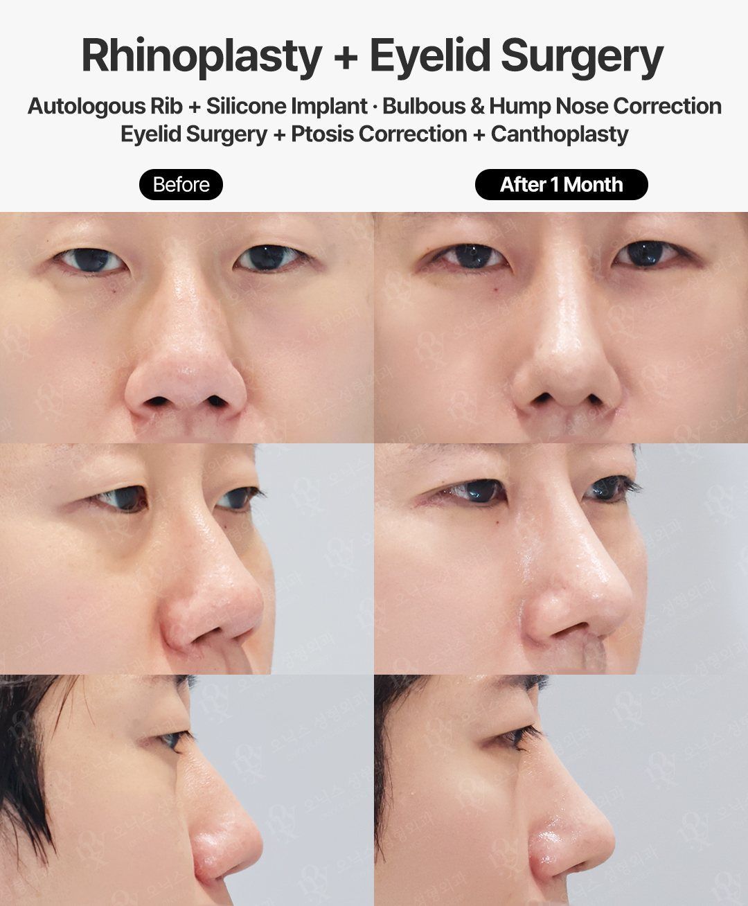 Rhinoplasty and eyelid surgery before and after in Korea: hump and bulbous tip corrected with autologous rib cartilage and silicone, plus ptosis correction and canthoplasty, 1 month after surgery