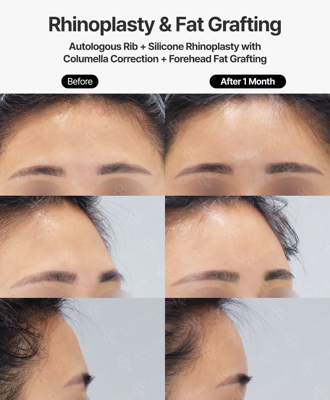 Forehead fat grafting before and after in Korea, done with rhinoplasty: front, oblique and profile views of a fuller, rounder forehead 1 month after surgery