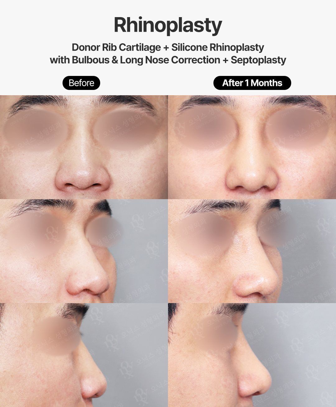 Rhinoplasty before and after in Korea: front, oblique and profile views of a bulbous, long nose corrected with donor rib cartilage, silicone implant and septoplasty, 1 month after surgery