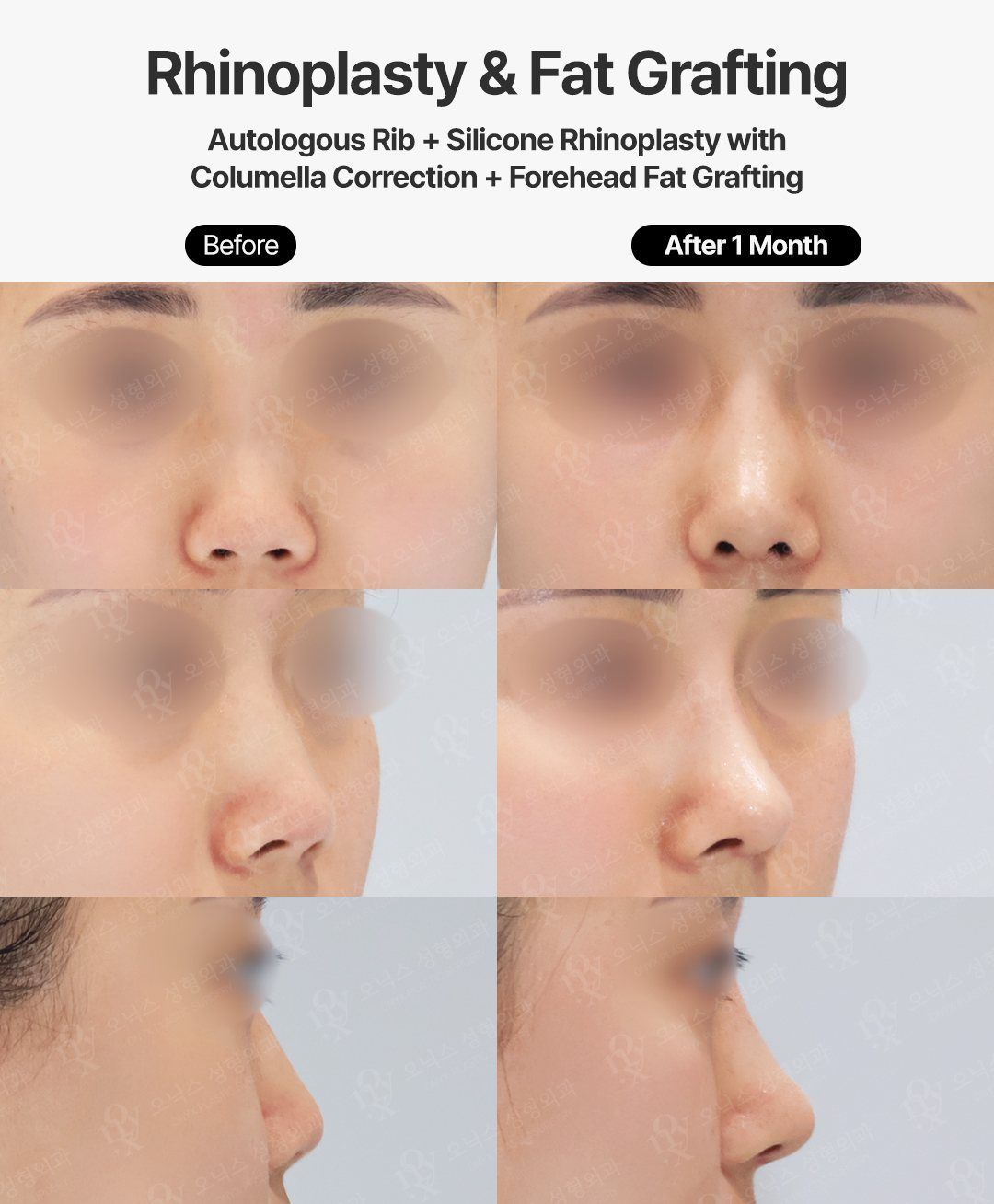 Rhinoplasty before and after in Korea: low bridge and retracted columella corrected with autologous rib cartilage and silicone implant, front, oblique and side views, 1 month after surgery