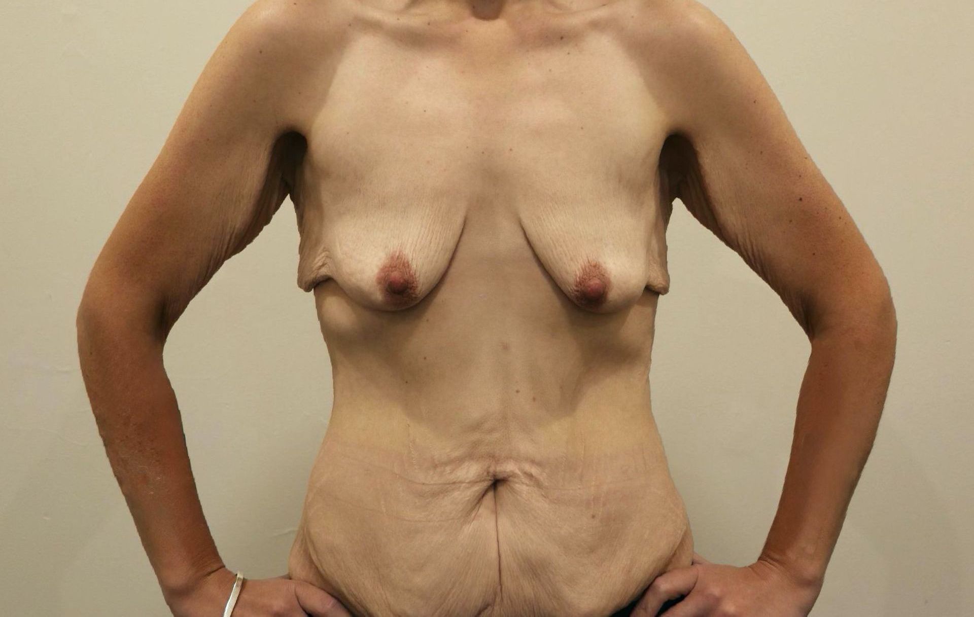 Breast Lift Before
