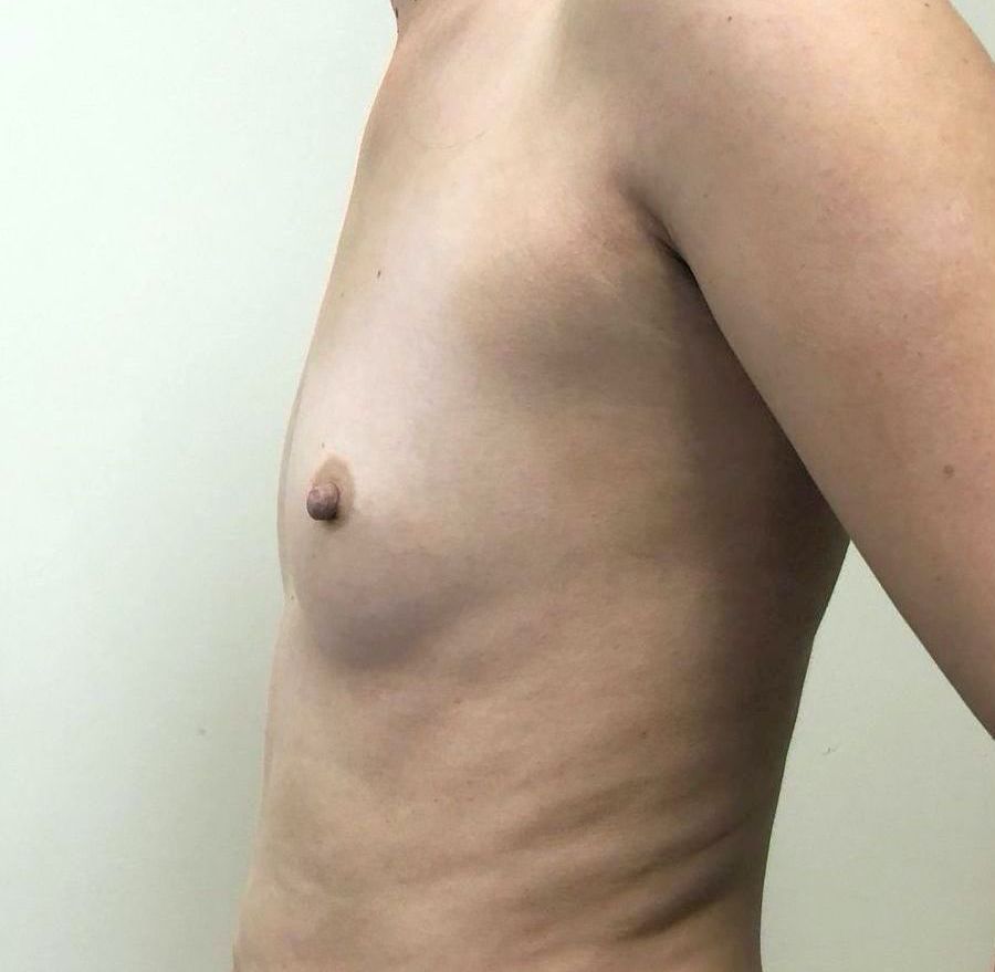 Breast Augmentation Before