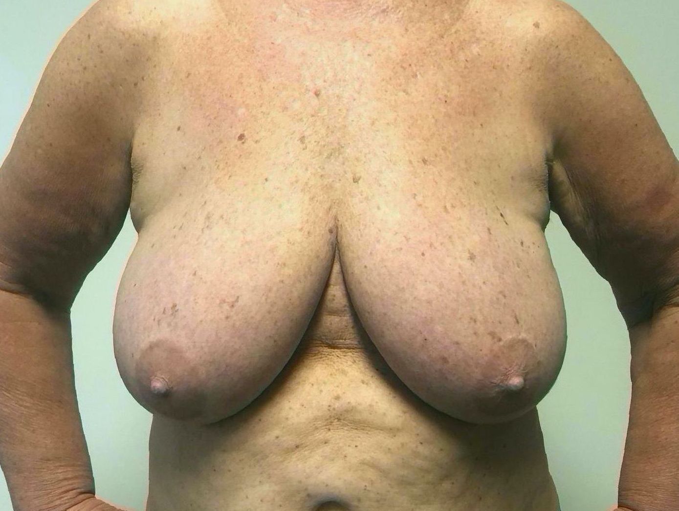 Breast Reduction Before