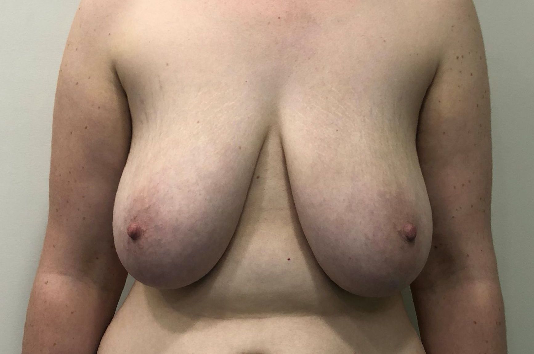 Breast Reduction Before