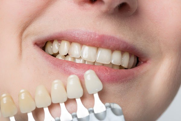 Strahlende Zähne durch Bleaching