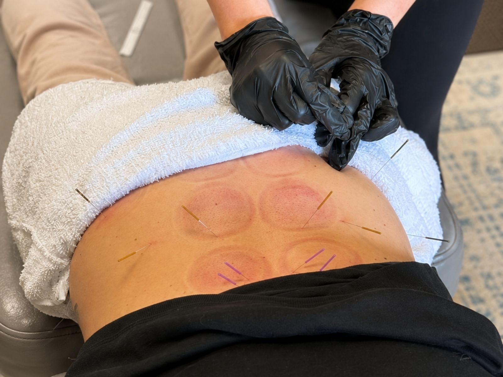 Dry needling treatment performed on a patient's lower back at Raise Chiropractic in Littleton, Colorado