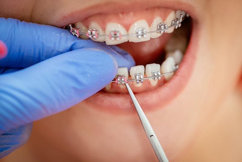 Una mujer con aparatos ortopédicos se hace examinar los dientes por un dentista.