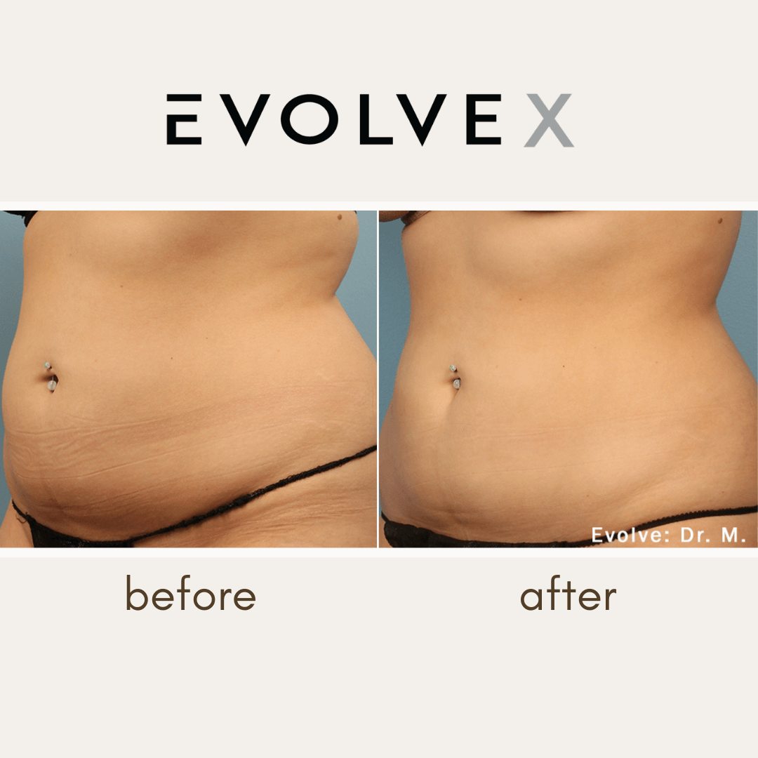 Evolve X transform before and after Stomach