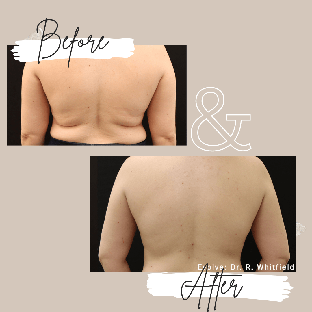 Evolve X transform before and after Back