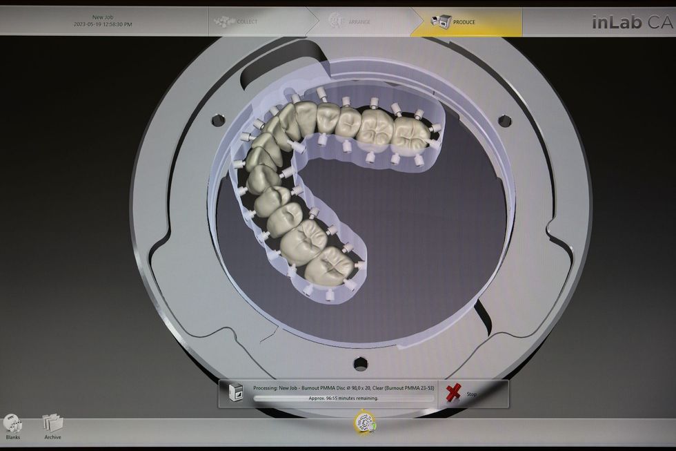 Digital dental scan of upper teeth within a circular scanning device.