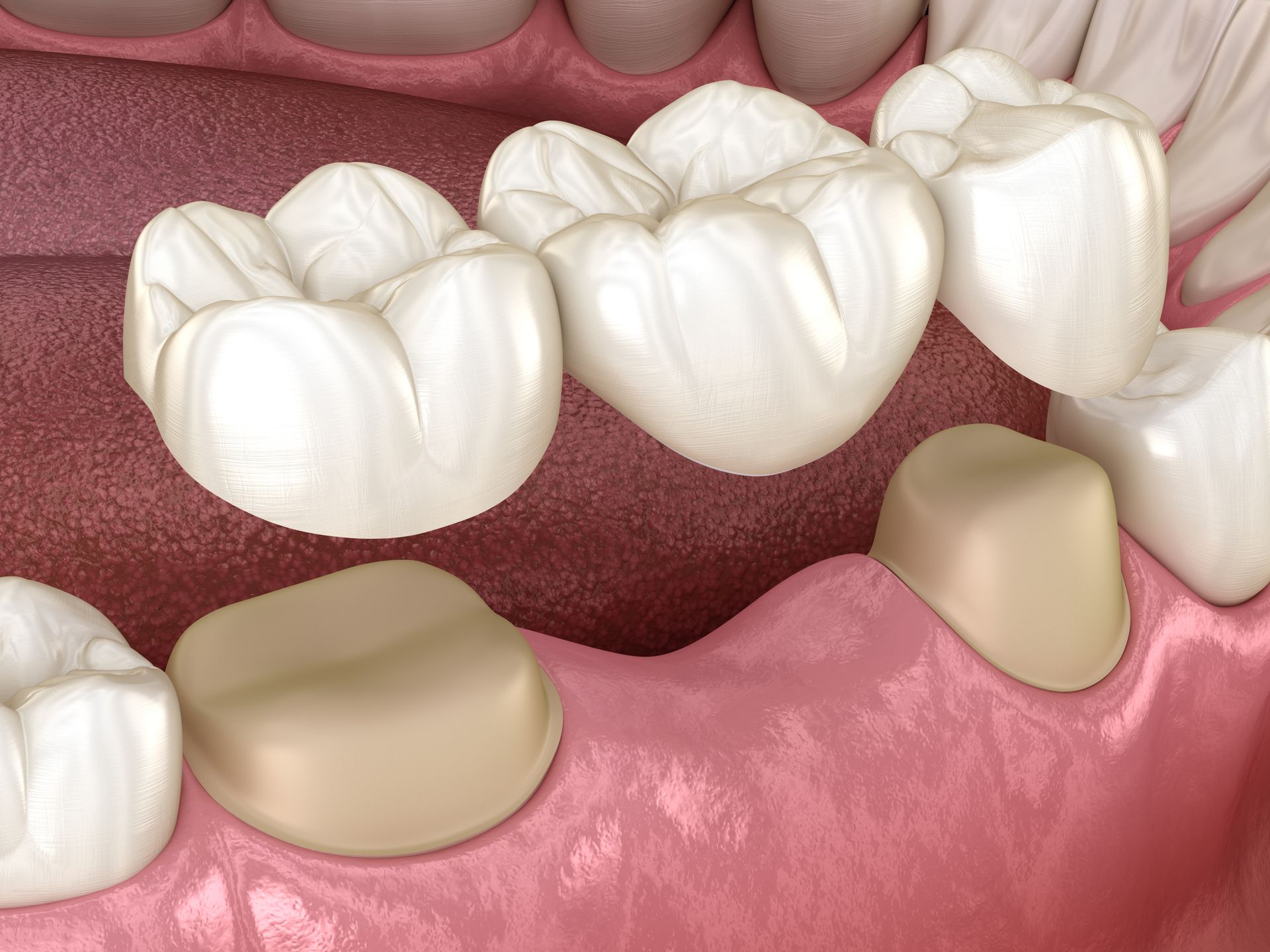 Dental bridge: prosthetic teeth anchored to adjacent teeth in pink gums.