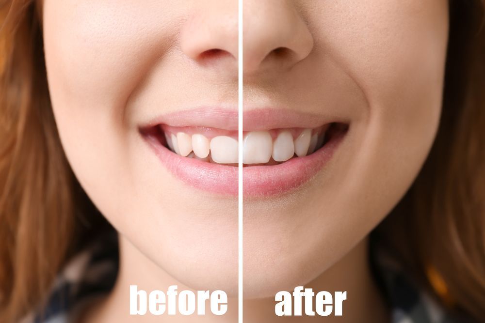 Comparaison côte à côte : visage souriant avec des dents tachées à gauche (« avant ») et des dents plus blanches à droite (« après »).