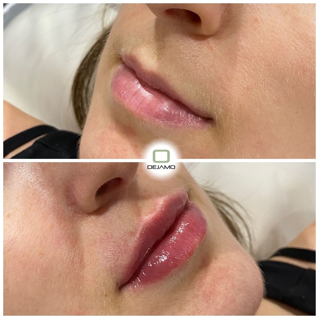 A before and after photo of a woman 's lips.
