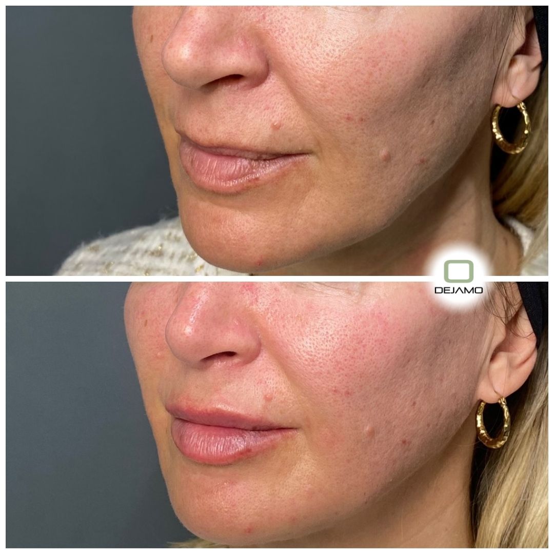 A before and after photo of a woman 's face.