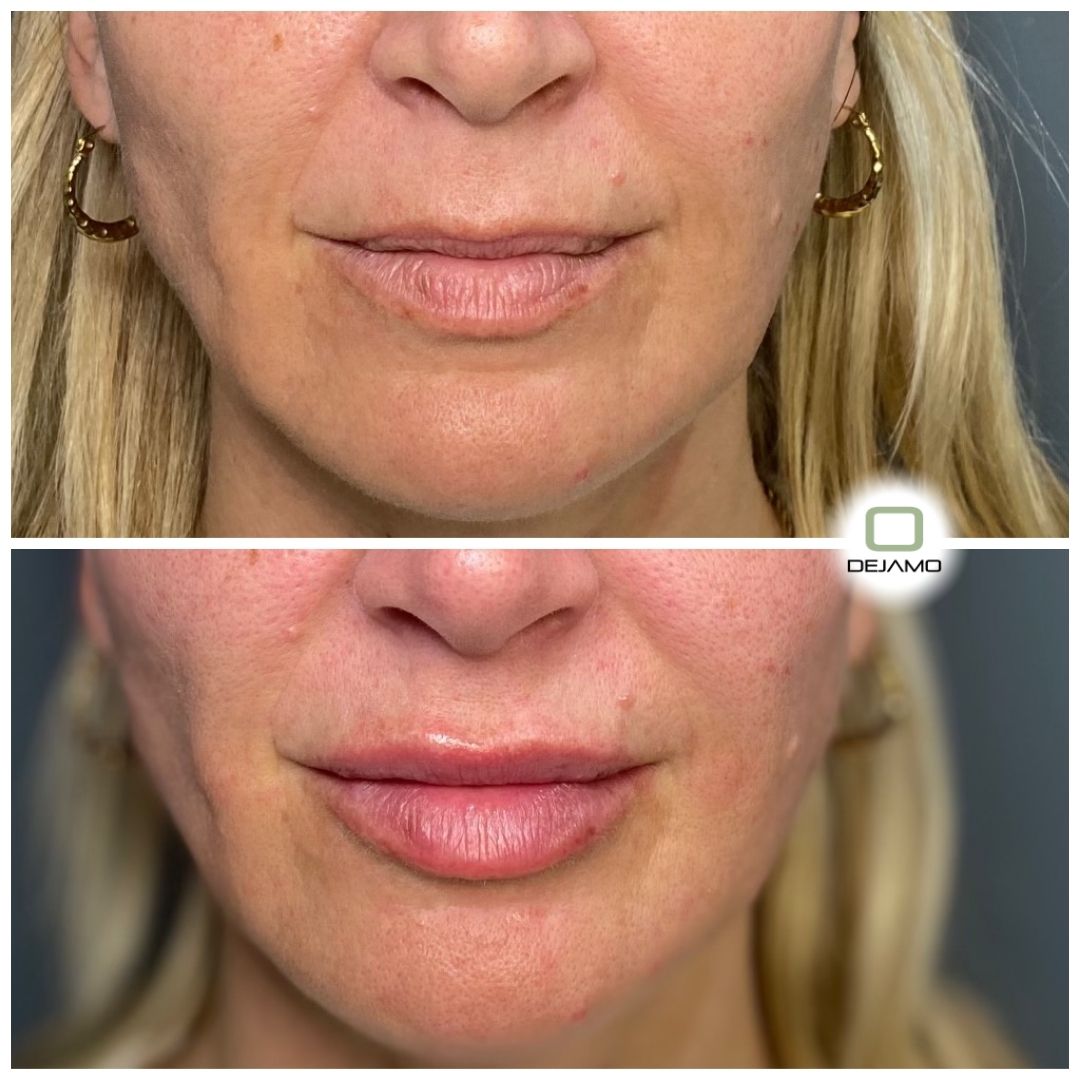 A before and after photo of a woman 's lips.