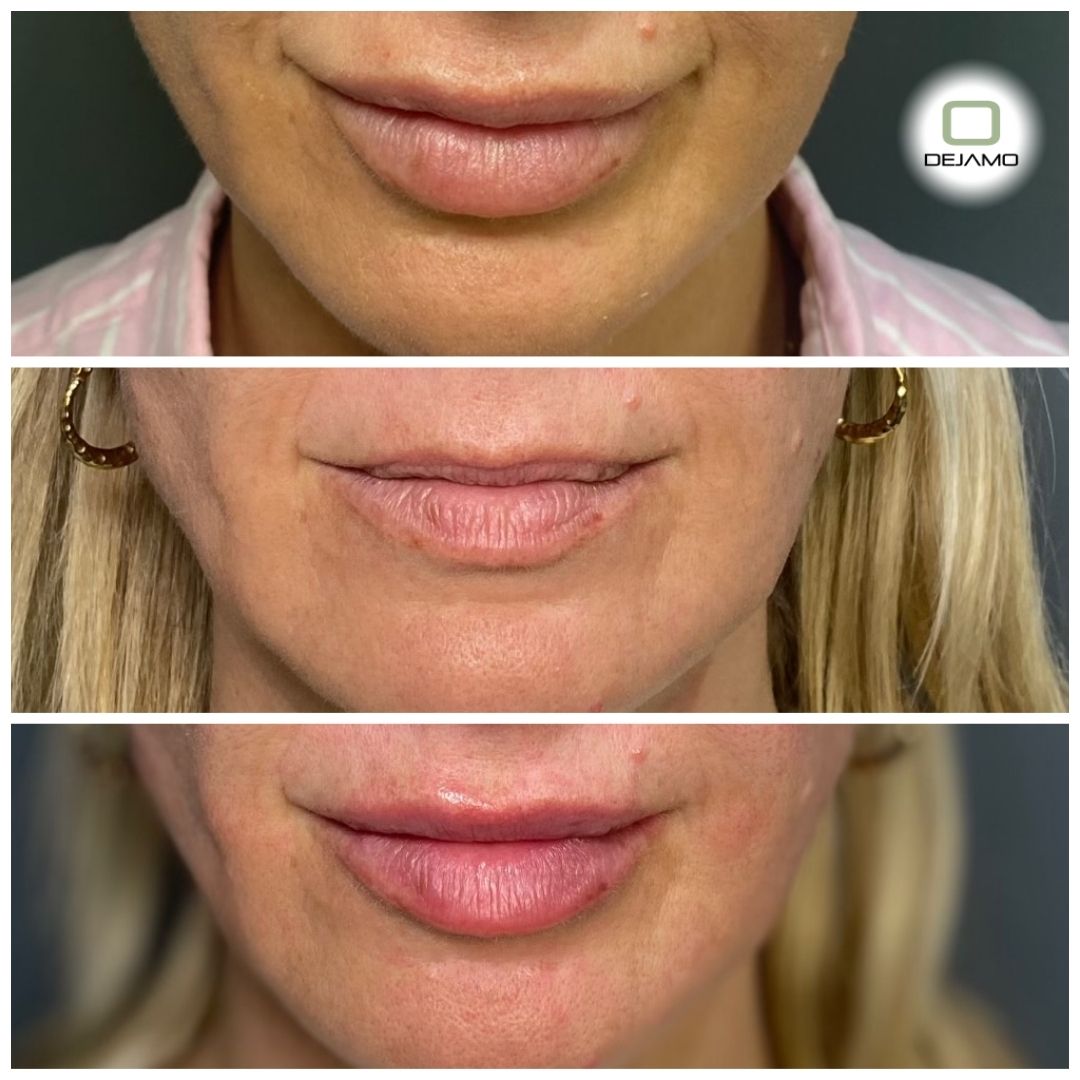 A before and after photo of a woman 's lips.