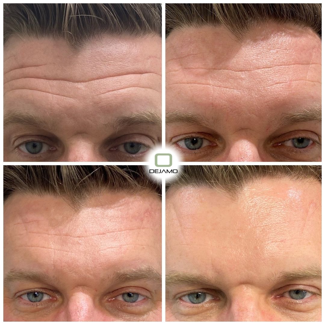 A before and after photo of a man 's forehead