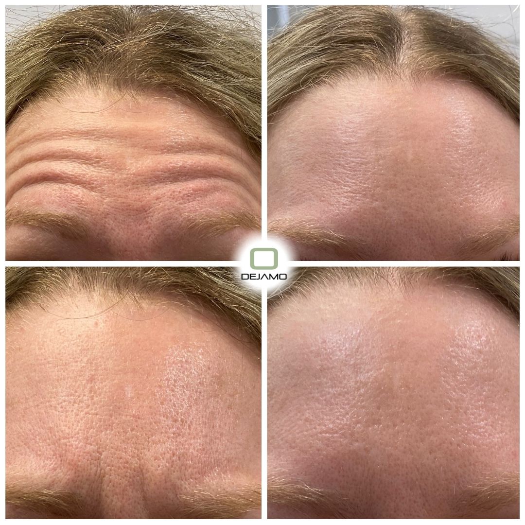 A before and after photo of a man 's forehead.