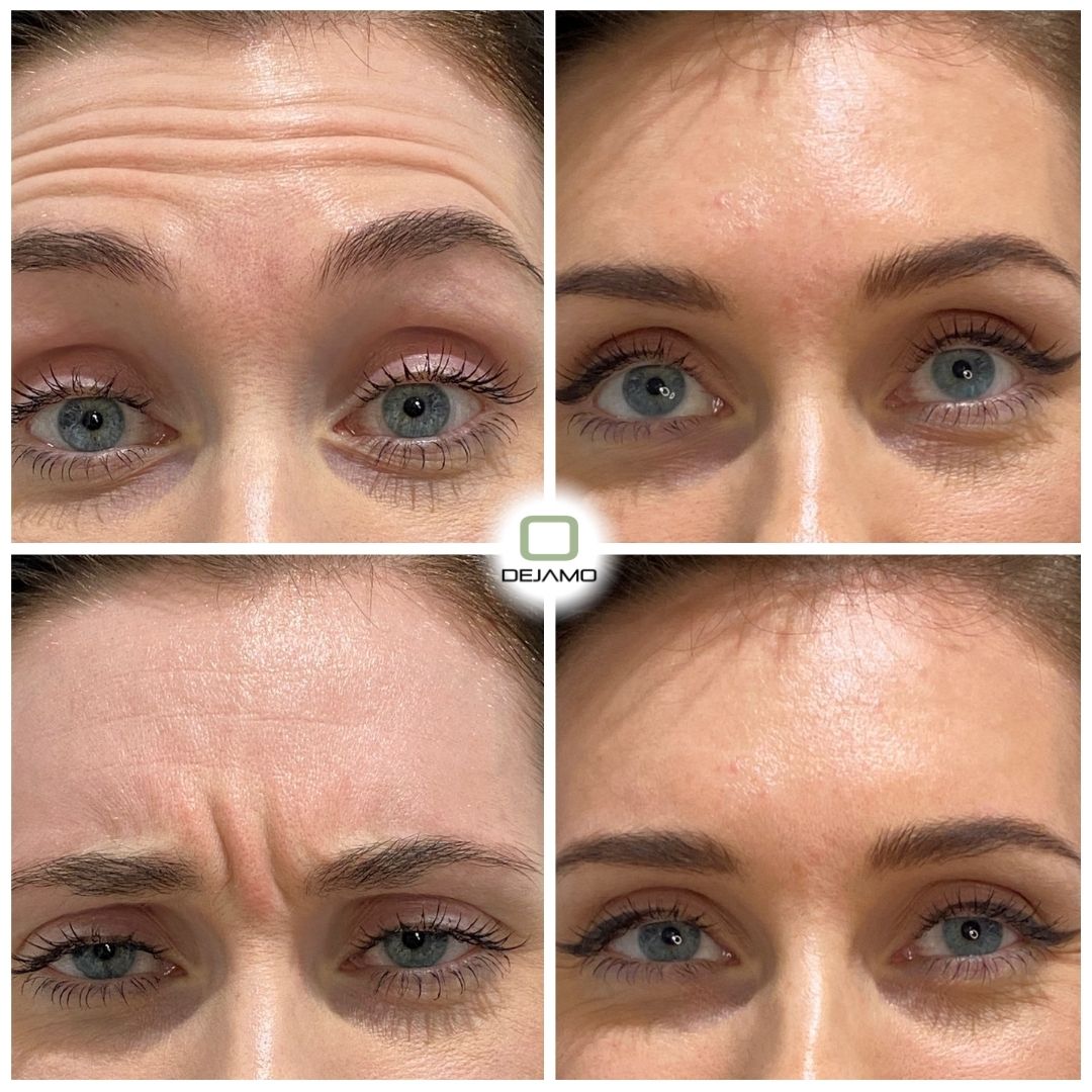 A woman 's forehead is shown before and after botox injections.