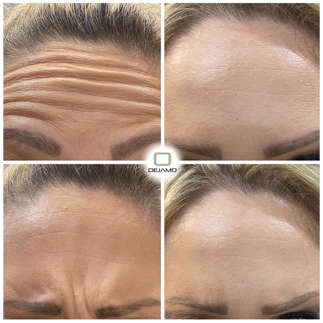 A woman 's forehead before and after botox injections.