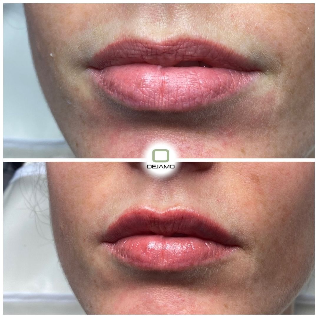 A before and after picture of a woman 's lips.