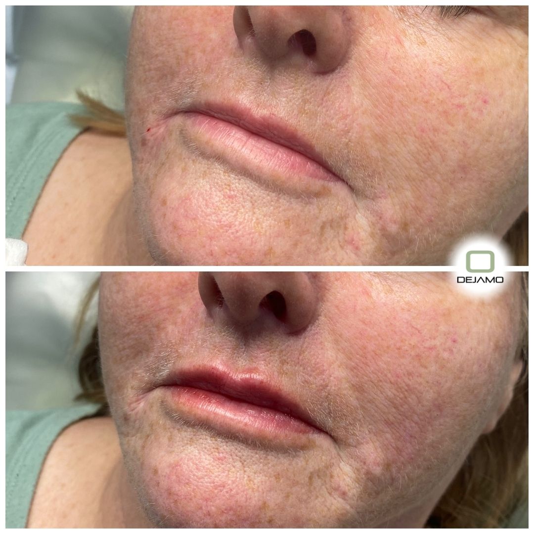 A before and after photo of a woman 's lips.