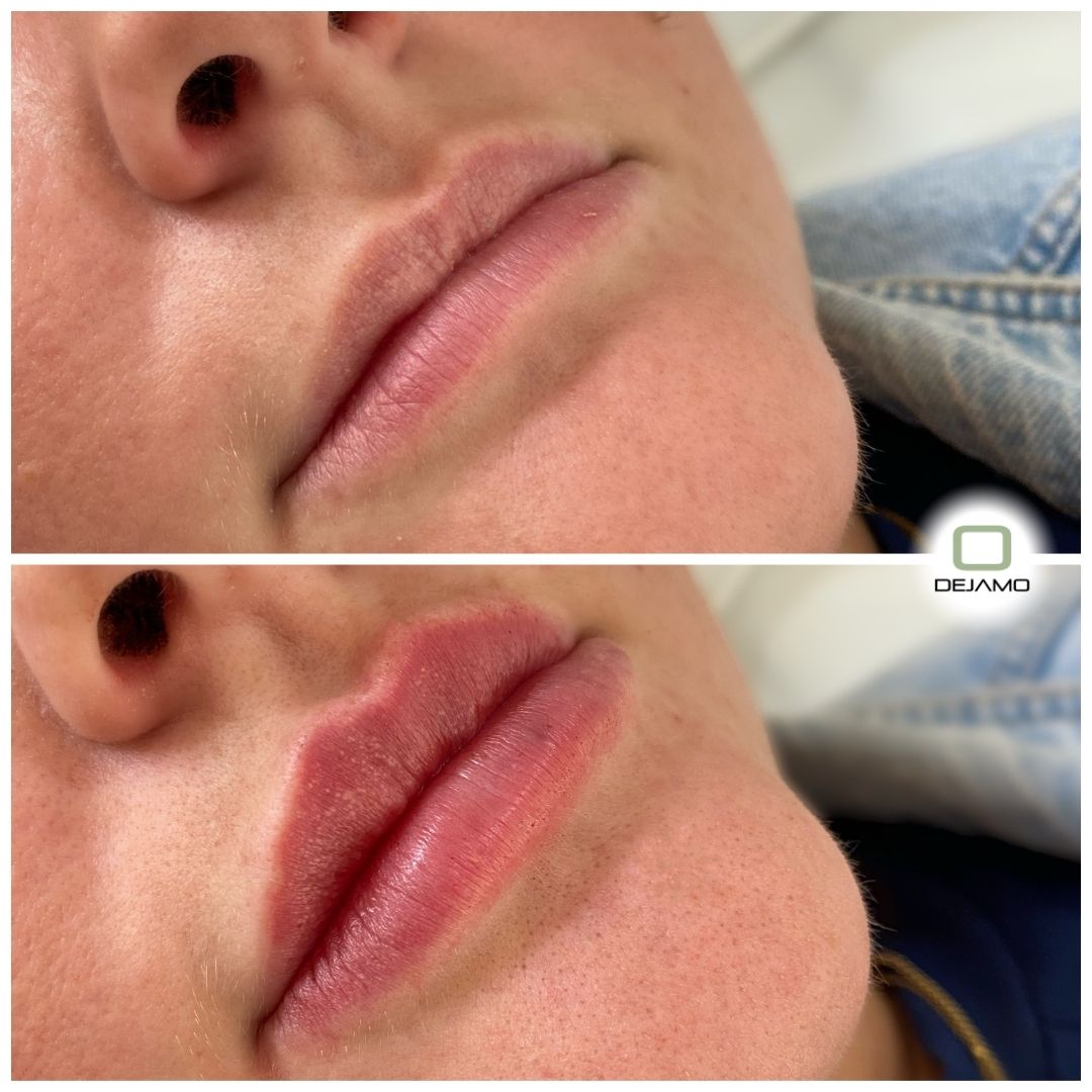 A before and after photo of a woman 's lips.