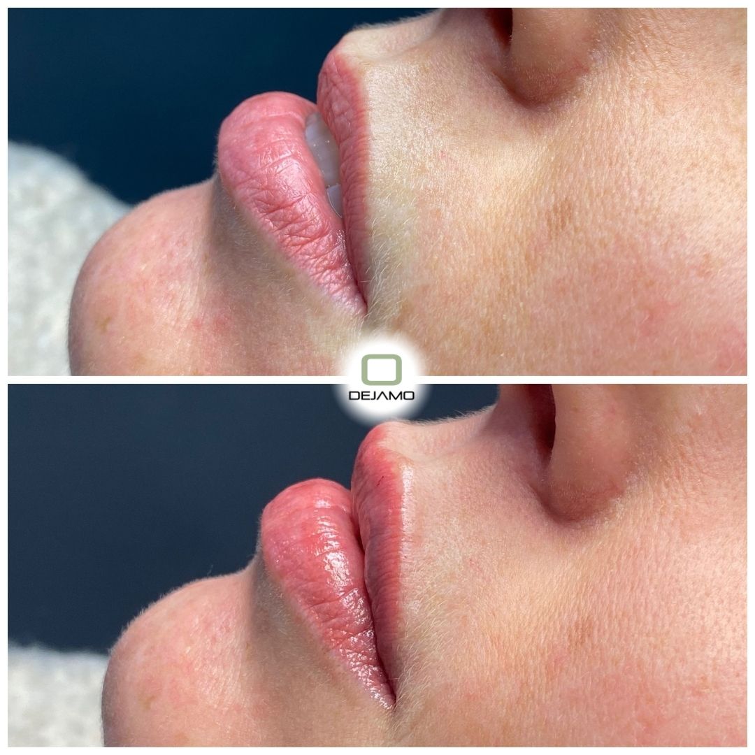 A before and after picture of a woman 's lips.