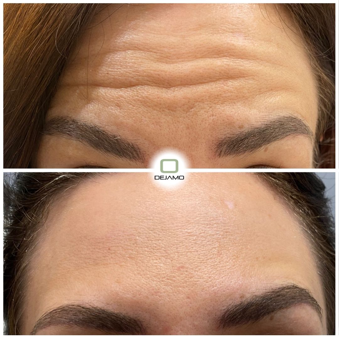 A before and after photo of a woman 's forehead.