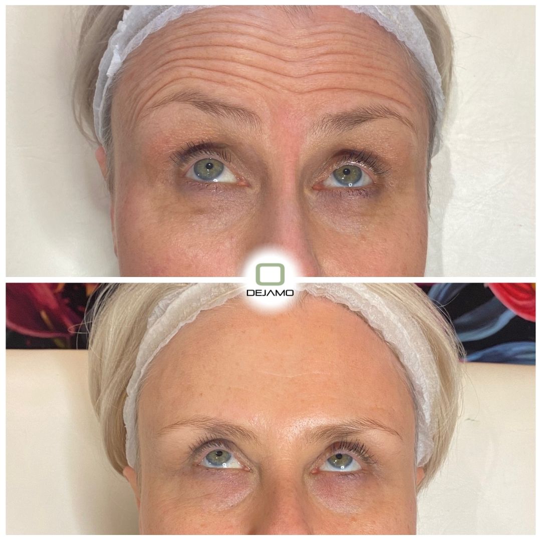 A before and after photo of a woman 's forehead