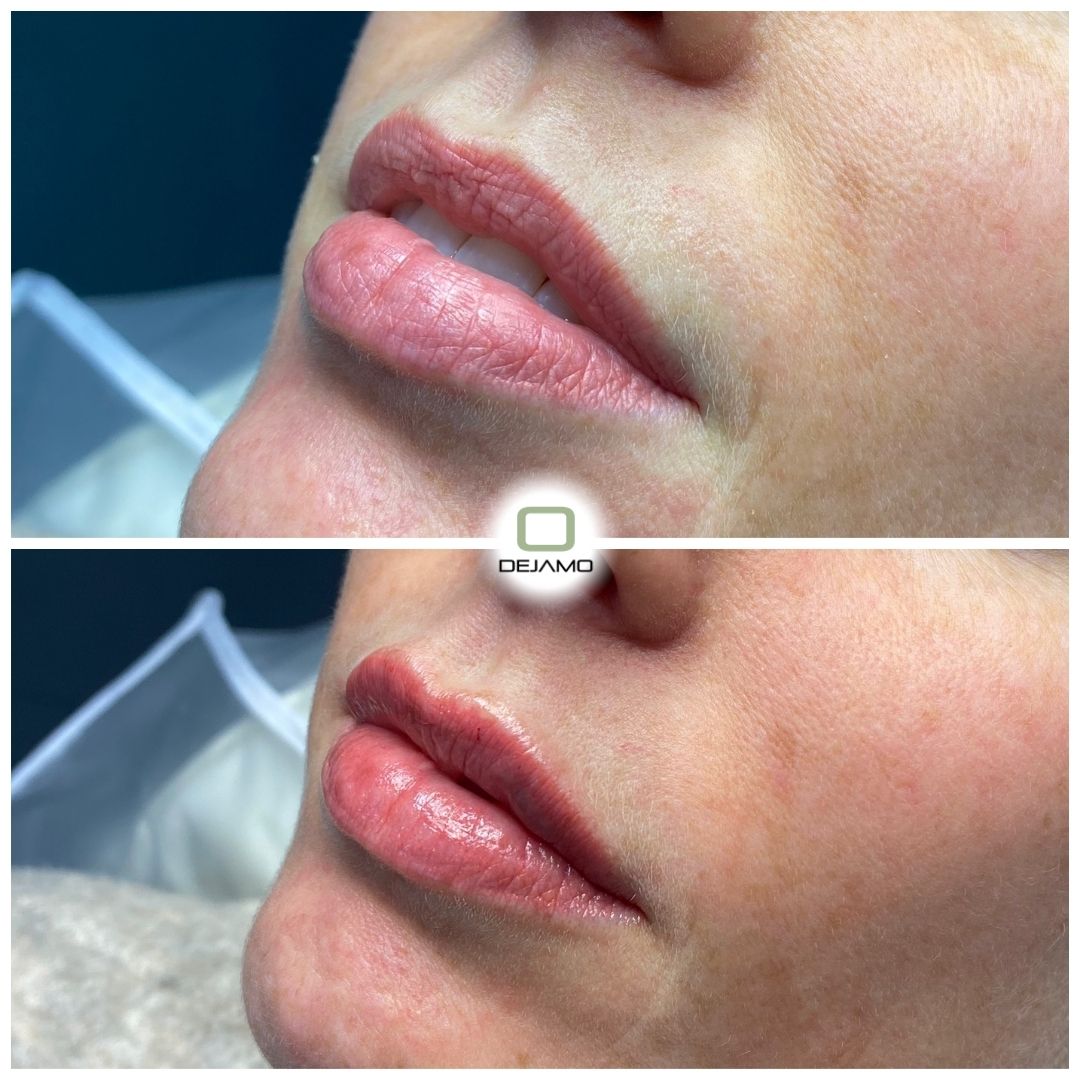 A before and after photo of a woman 's lips.