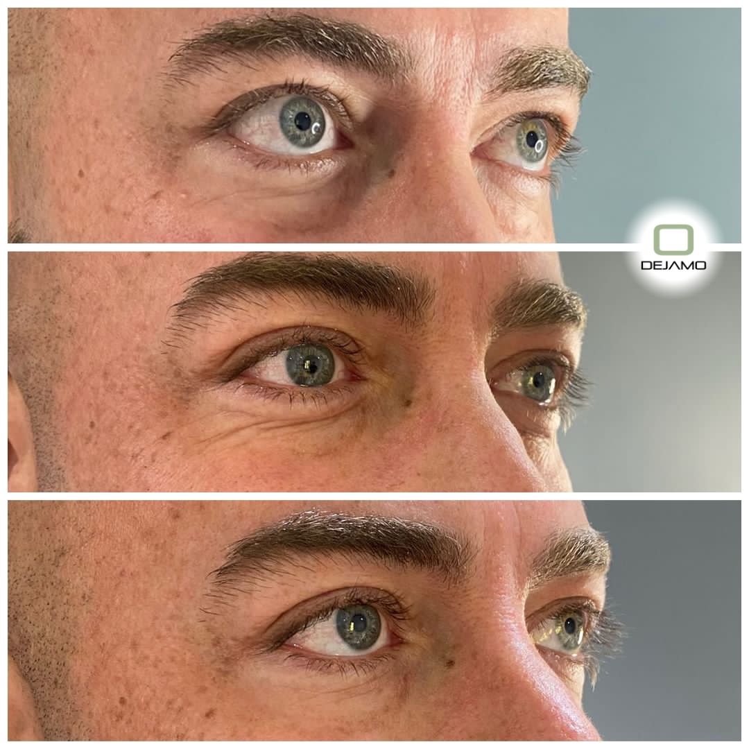 A man 's eyes are shown in three different angles.
