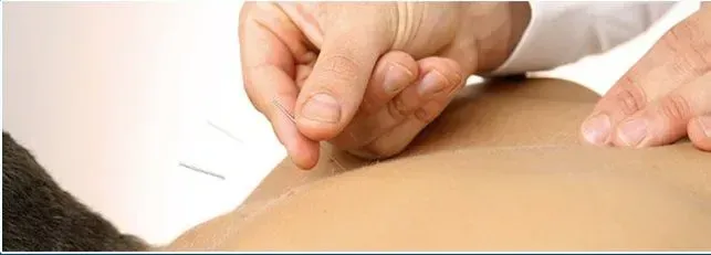 A person is getting acupuncture on their back.