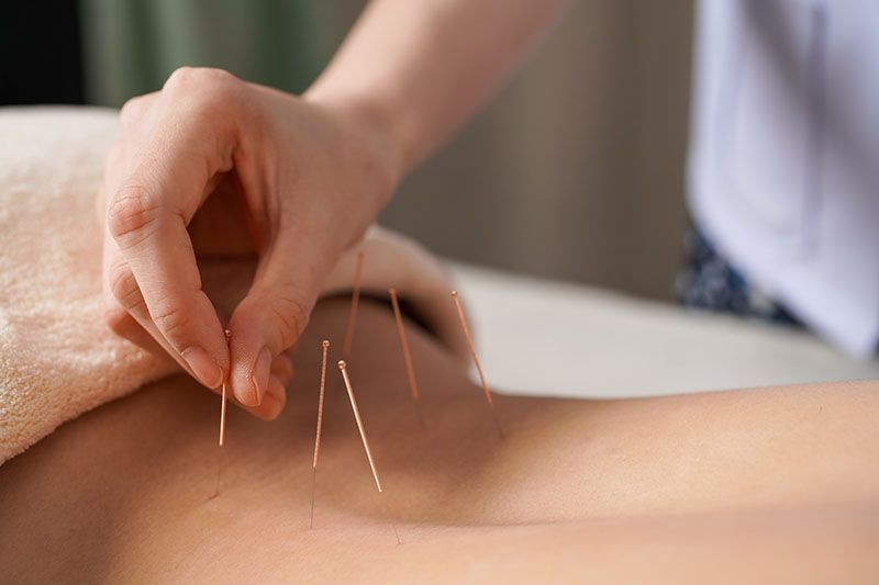 A person is getting acupuncture on their back.