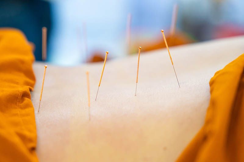 A person is getting acupuncture on their back.