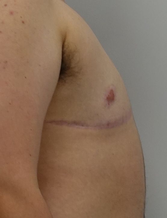 Double Incision with Free Nipple Grafts | Top Surgery Center of Connecticut