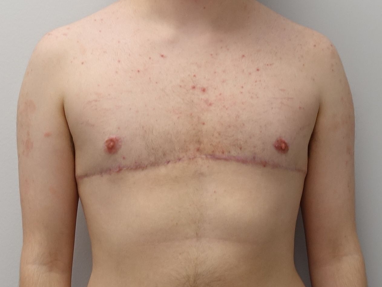 Double Incision with Free Nipple Grafts | Top Surgery Center of Connecticut