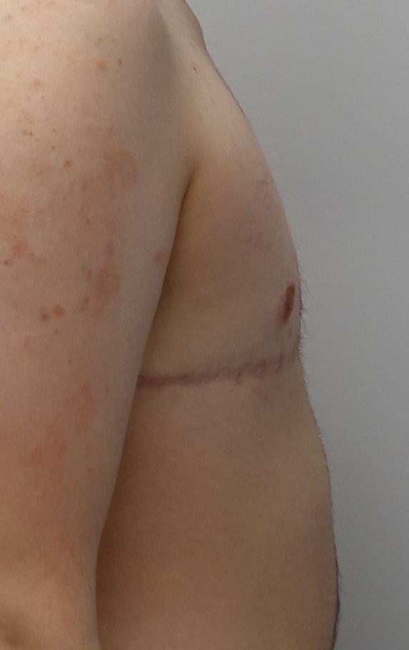Double Incision with Free Nipple Grafts | Top Surgery Center of Connecticut