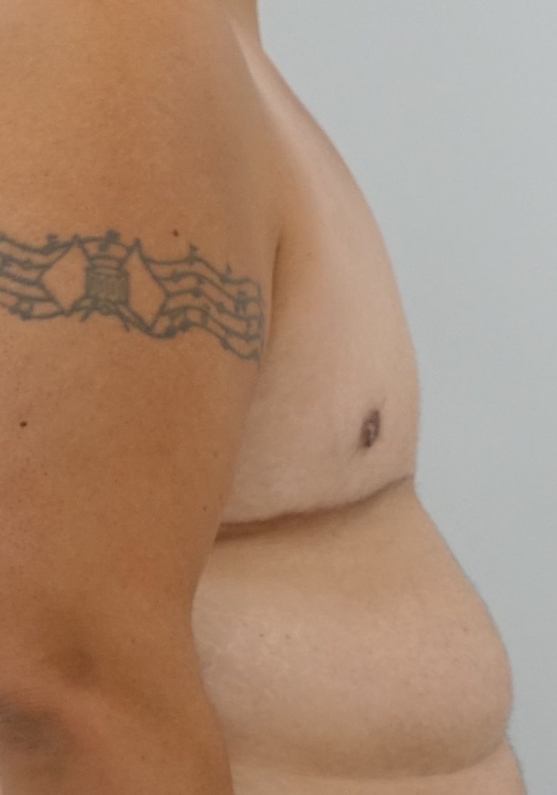 Double Incision with Free Nipple Grafts | Top Surgery Center of Connecticut