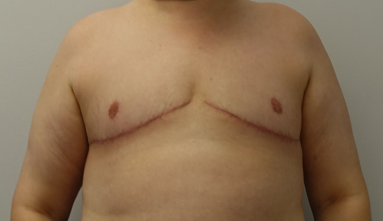 Double Incision with Free Nipple Grafts | Top Surgery Center of Connecticut