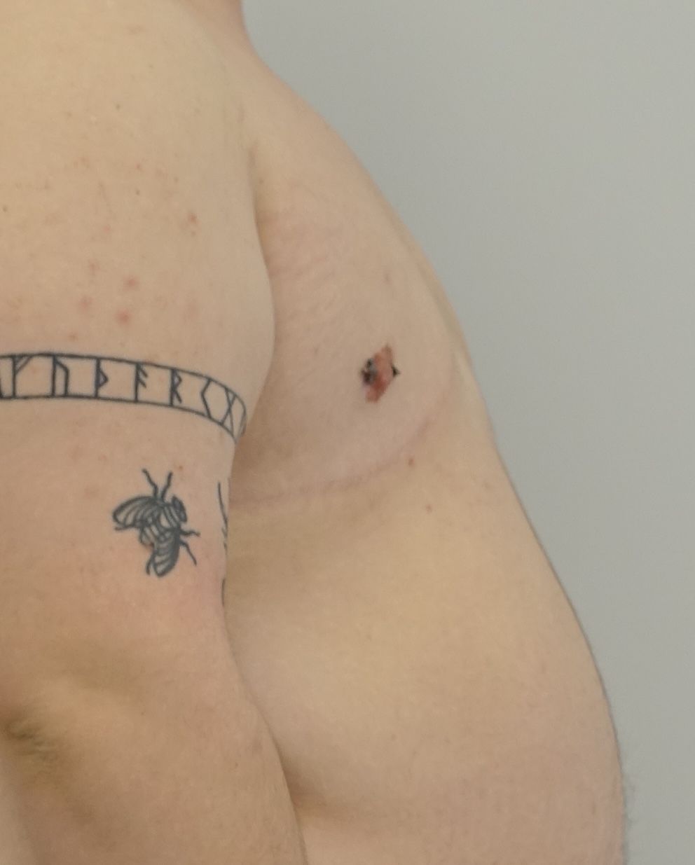 Double Incision with Free Nipple Grafts | Top Surgery Center of Connecticut