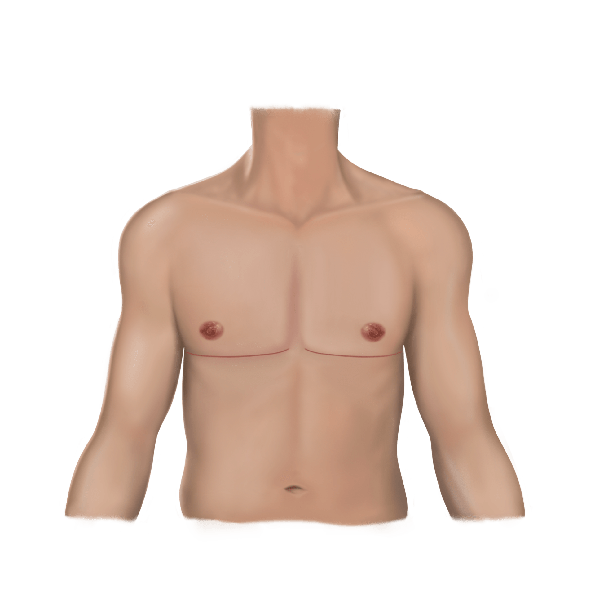 Double Incision Top Surgery | Top Surgery Center of Connecticut
