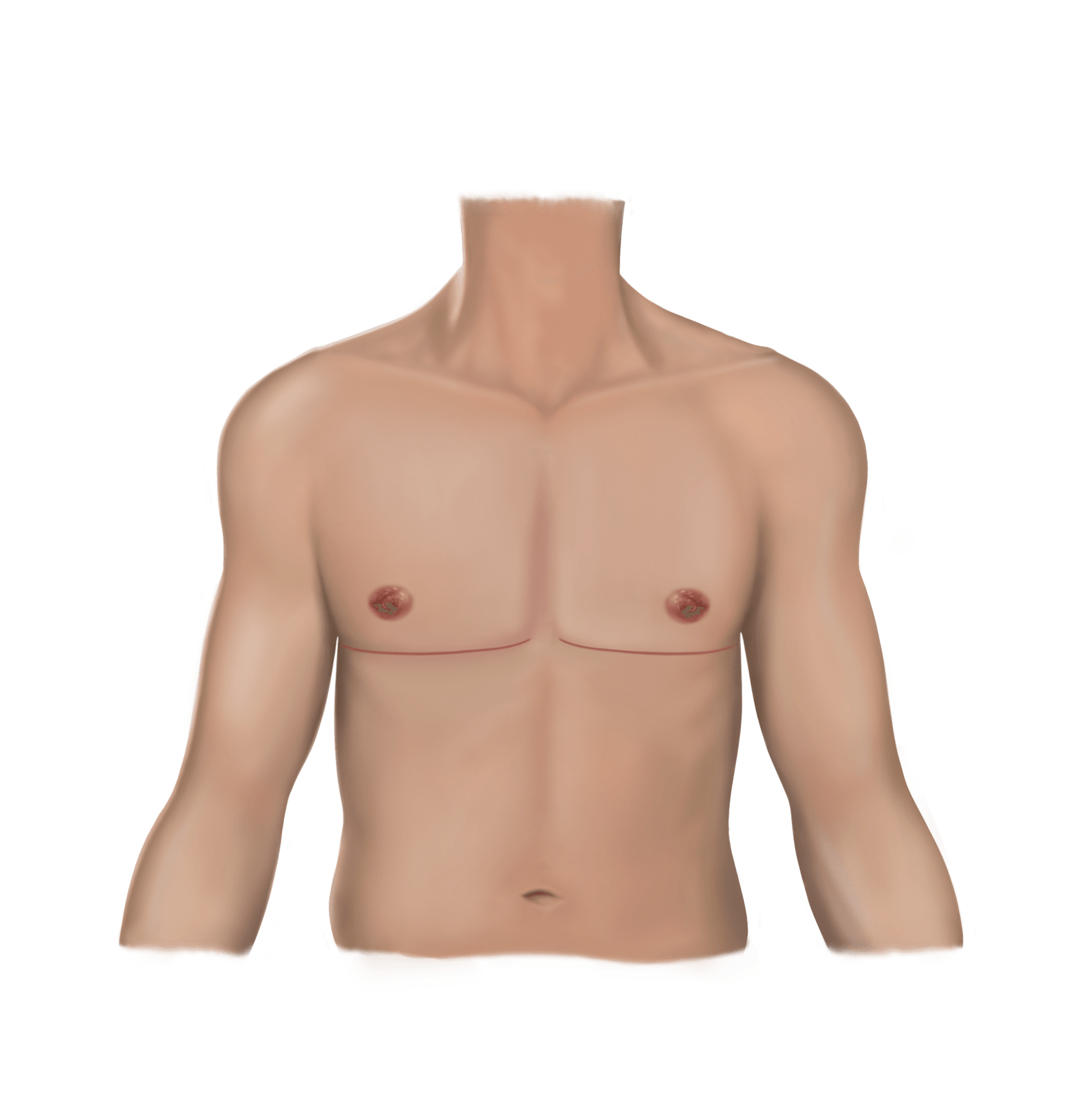 Lollipop Incision Liposuction | Top Surgery Center of Connecticut