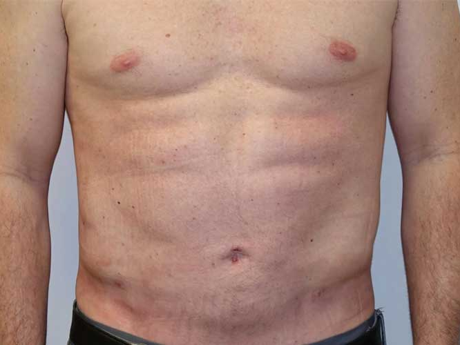 Body Contouring
