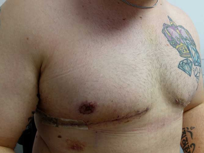 Gynecomastia