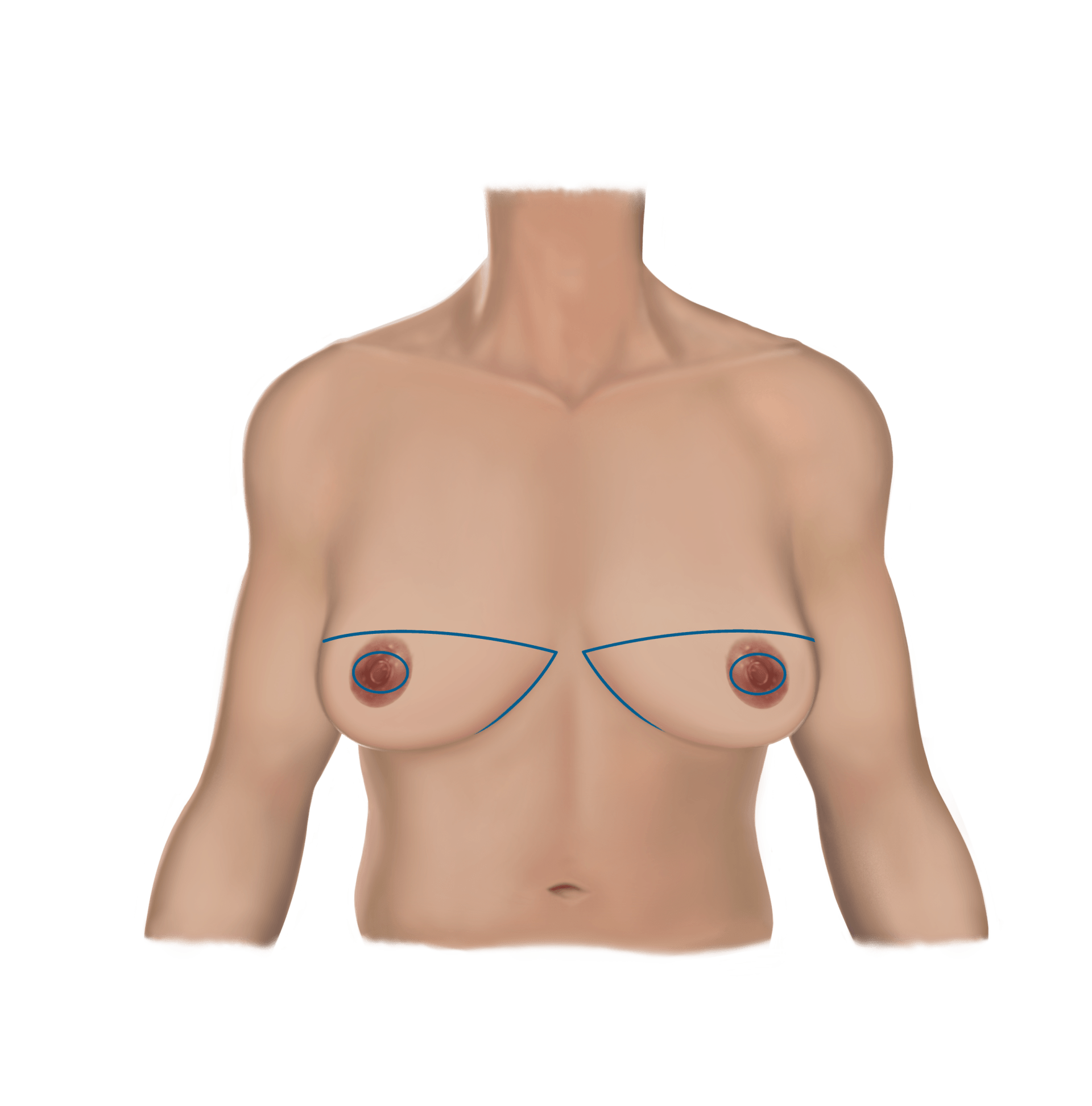 Double Incision-Pre