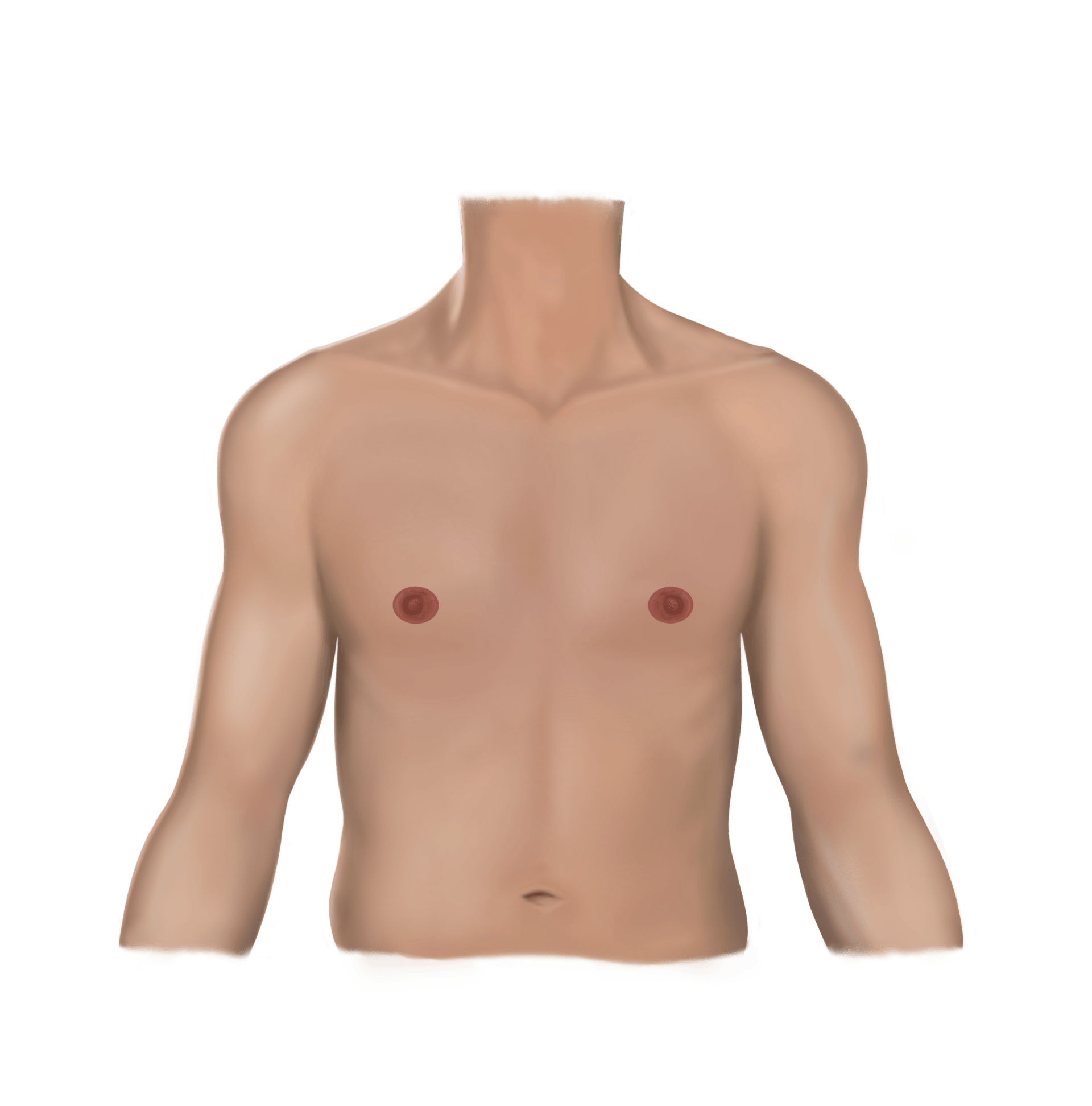 Periareolar - Post