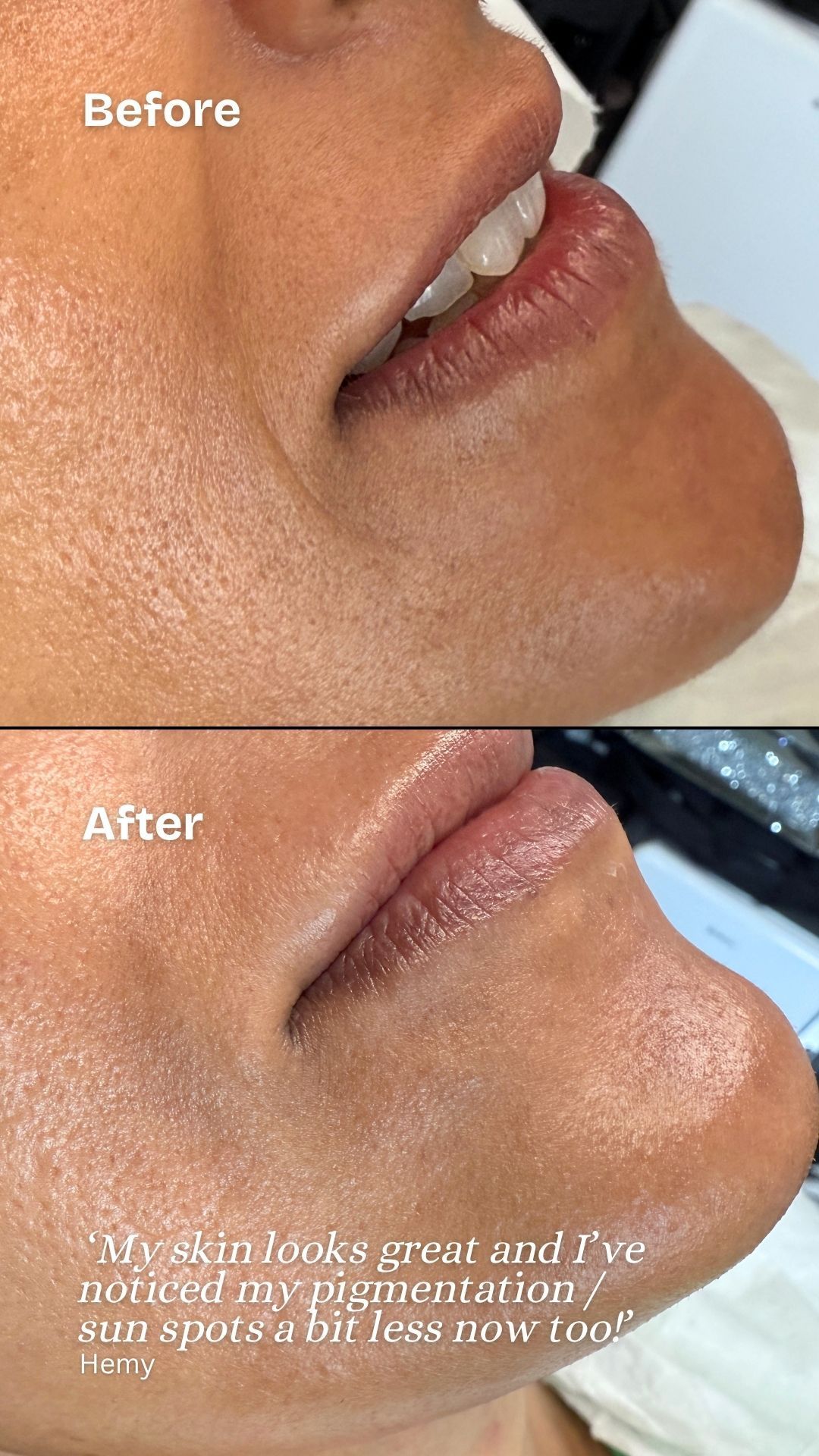 aqua pro hydration facial skin rejuvenation results by Jax-Glam Beauty Bristol