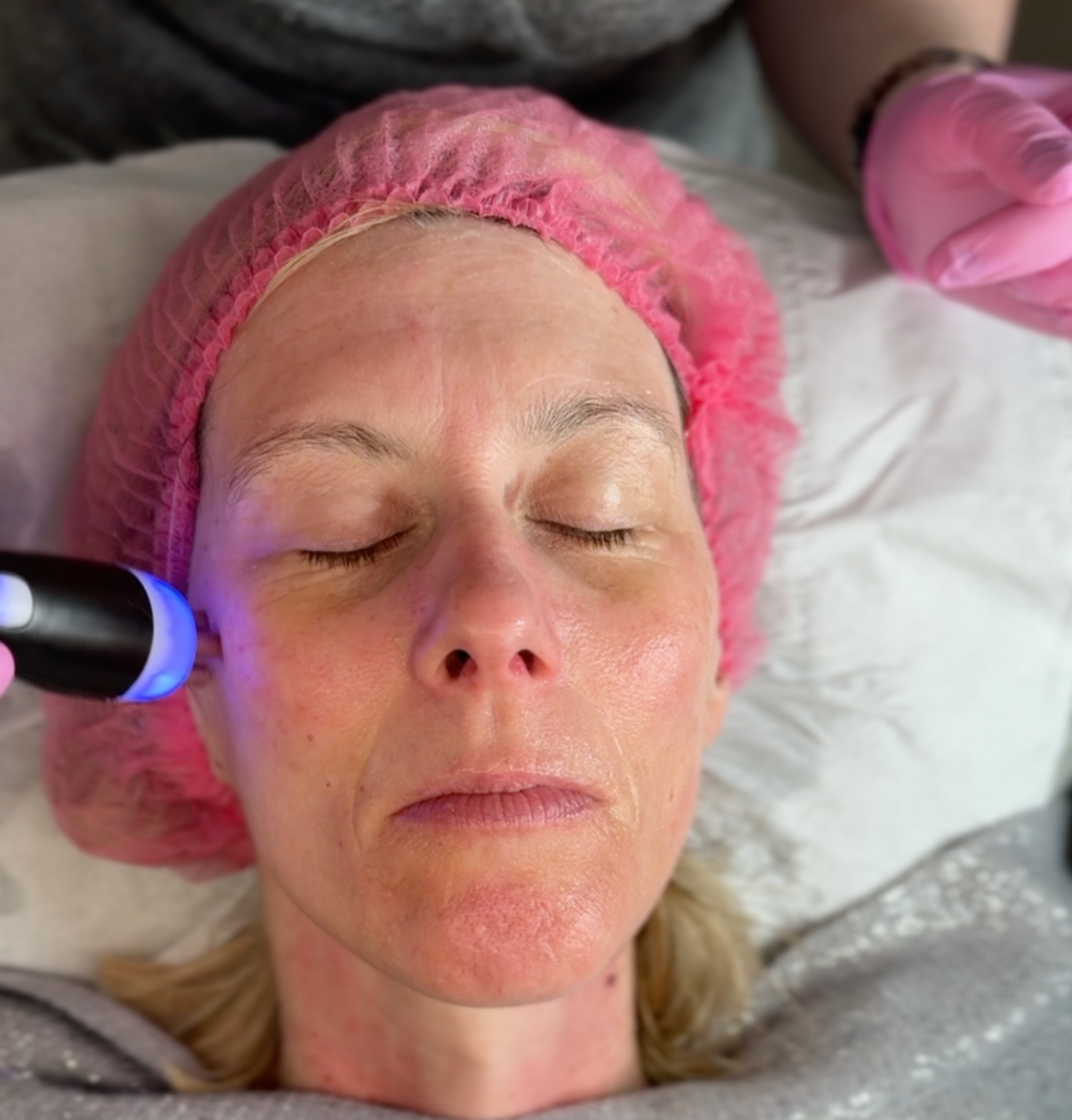 Radio frequency facial before and after around the eye area
