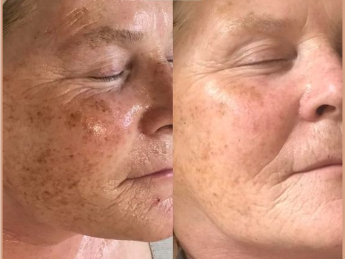 Chemical peel facial for smoother brighter skin in Bristol